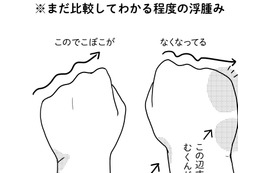 術後9ヵ月に発症した「リンパ浮腫」。有効なケア法を試してみたら、むくみ具合が…【乳癌日記 #50】