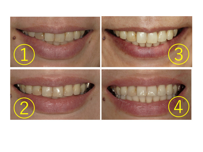 歯列矯正終了後、ホワイトニングをしても「茶色い治療済歯」が目立って悲しい。「ウォーキング・ブリーチ」してみたら？