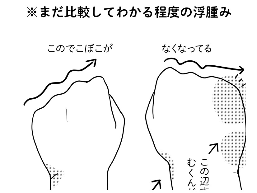 術後9ヵ月に発症した「リンパ浮腫」。有効なケア法を試してみたら、むくみ具合が…【乳癌日記 #50】