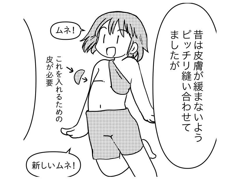 胸の全摘手術。昔と今の「縫い方」の違いは、胸の「再建」のため【乳癌日記 #53】