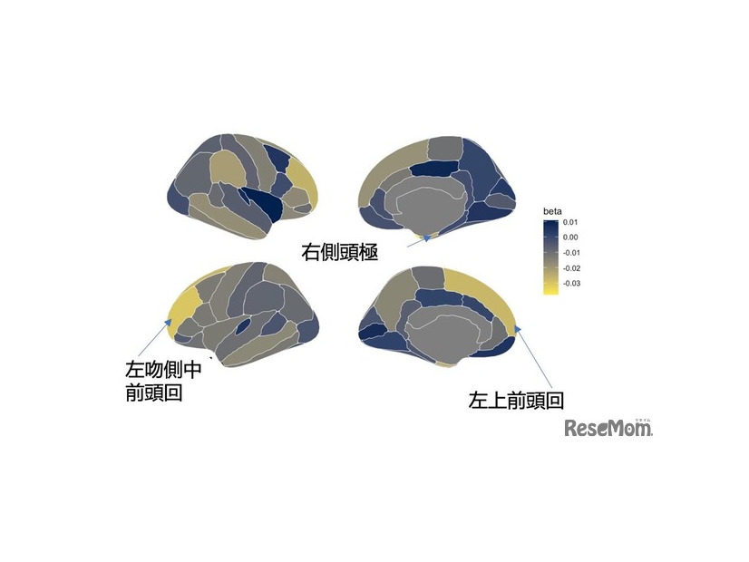 スクリーンタイムは右側頭極、左上前頭回、左吻側中前頭回などの脳領域で皮質厚の減少とも関連
