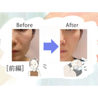 美容課金にハマった44歳が人生初のハイフを体験。「実は一番悩んでいた」たるみはどう変わるのか？気になる痛みは？