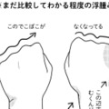 術後9ヵ月に発症した「リンパ浮腫」。有効なケア法を試してみたら、むくみ具合が…【乳癌日記 #50】 画像