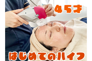 【美容】45歳、はじめてのハイフ。たるんだ顔はどれだけ変わるのか！？ 画像