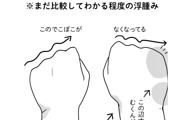 術後9ヵ月に発症した「リンパ浮腫」。有効なケア法を試してみたら、むくみ具合が…【乳癌日記 #50】