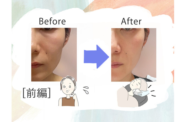 美容課金にハマった44歳が人生初のハイフを体験。「実は一番悩んでいた」たるみはどう変わるのか?気になる痛みは?