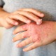 「ステロイドは怖い」は本当？ ここまで変わったアトピー性皮膚炎治療と、正しい外用薬の使い方