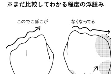 術後9ヵ月に発症した「リンパ浮腫」。有効なケア法を試してみたら、むくみ具合が…【乳癌日記 #50】 画像