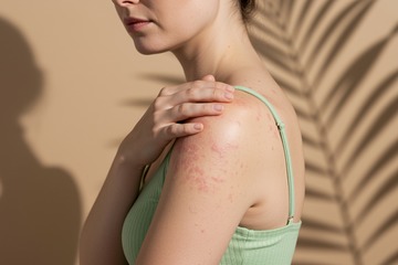 大人になってから発症・再燃することも。40代・50代のアトピー性皮膚炎【専門家監修】 画像